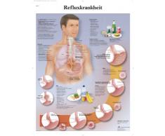3B Scientific - Póster explicativo sobre la enfermedad del reflujo (en alemán), 1